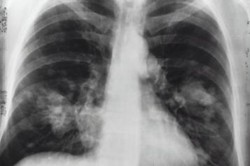 X-ray of lungs